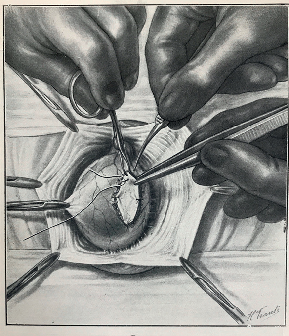 在1920年代,曾经有过一种疯狂的事,将黑猩猩的睾丸移植到男性身上.