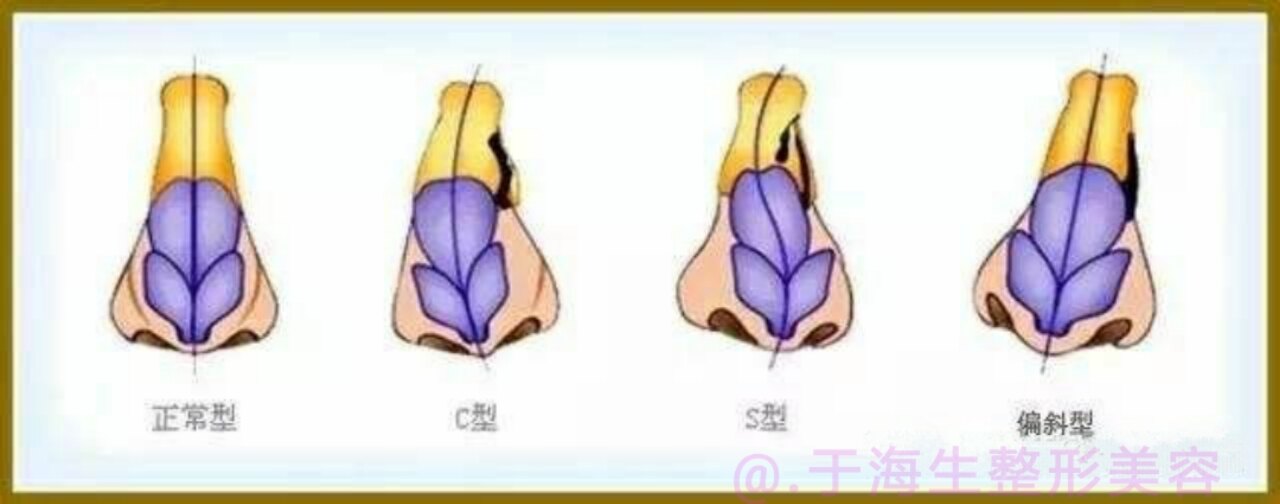 歪鼻是怎么形成的 有什么矫正的方法 鼻部整形
