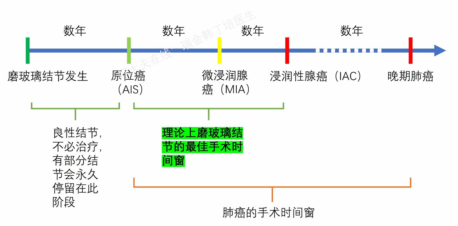 肺小结节磨玻璃结节手术治疗的时间窗磨玻璃结节什么时候手术最合适