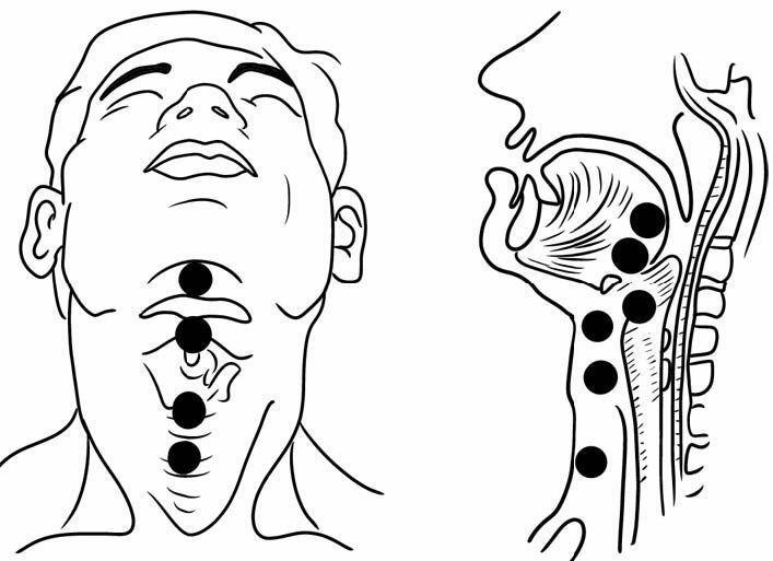 甲状舌管囊肿图片图片