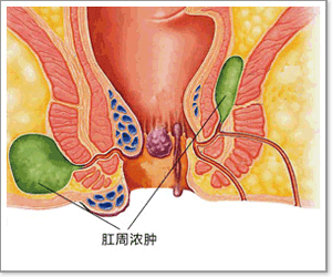 肛周脓肿怎样做到微创 肛周脓肿 肛周脓肿