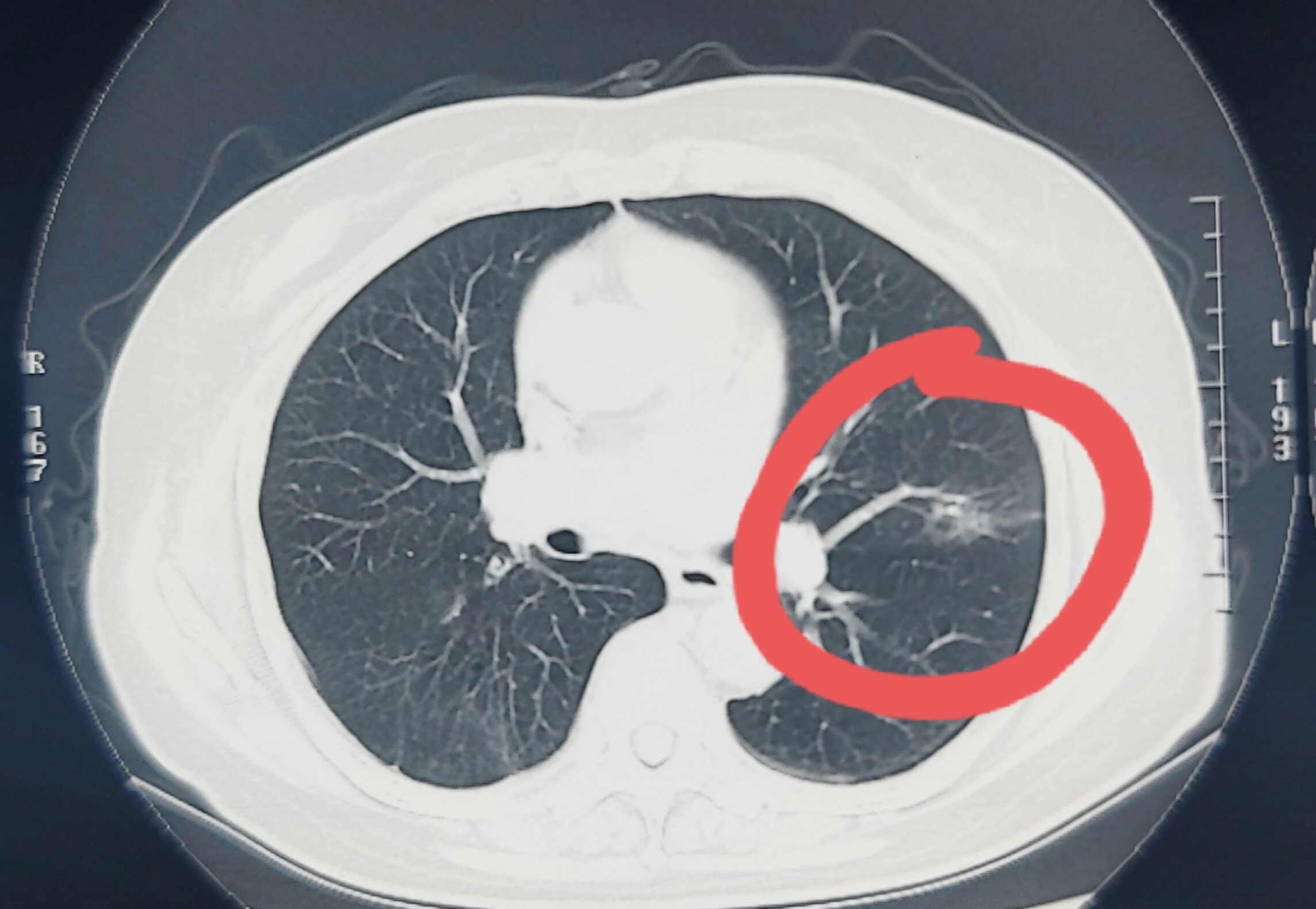 肺部结节 肺部结节