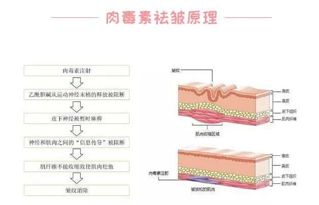 注射肉毒素除皱后会不会表情僵硬?