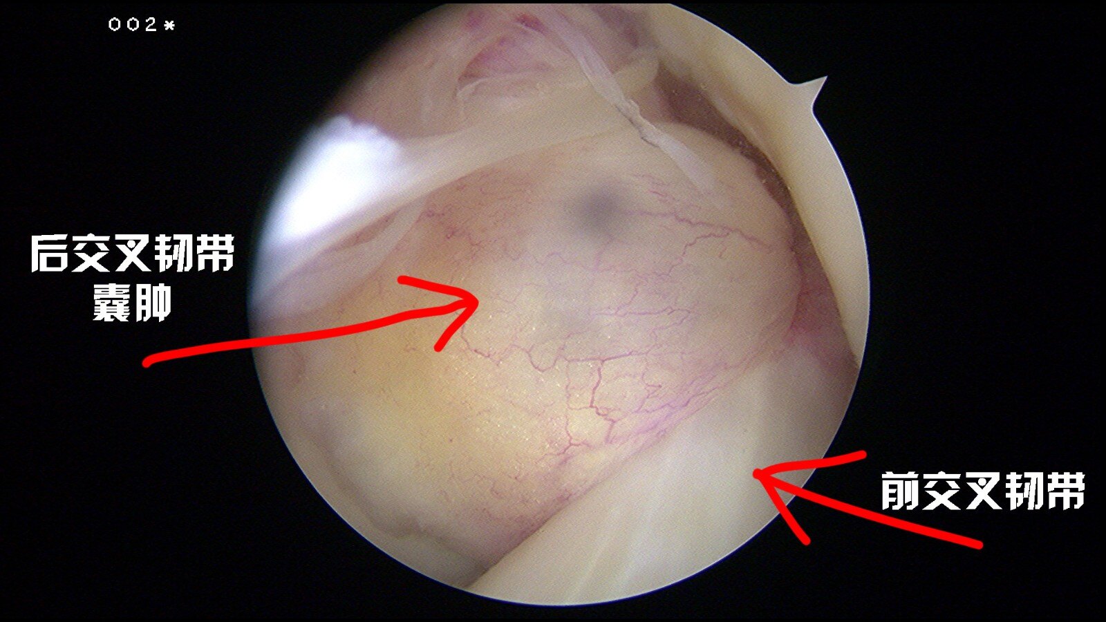 健康小伙突然膝盖伸不直,病因竟是罕见的交叉韧带囊肿!