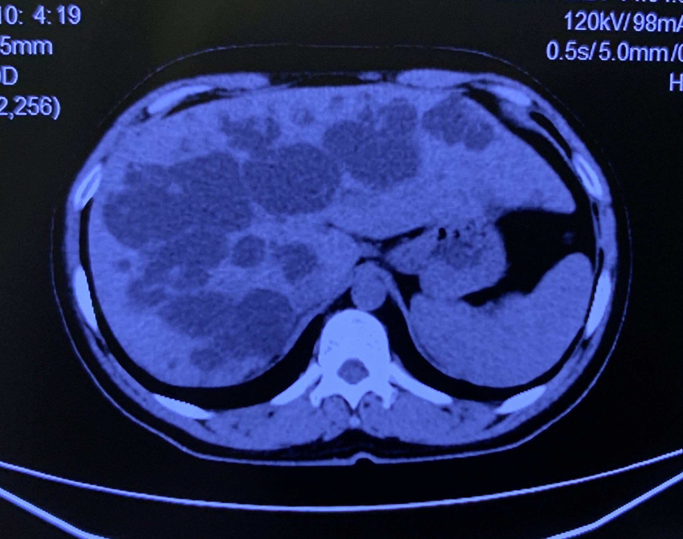 胰头增大胆管扩张图片