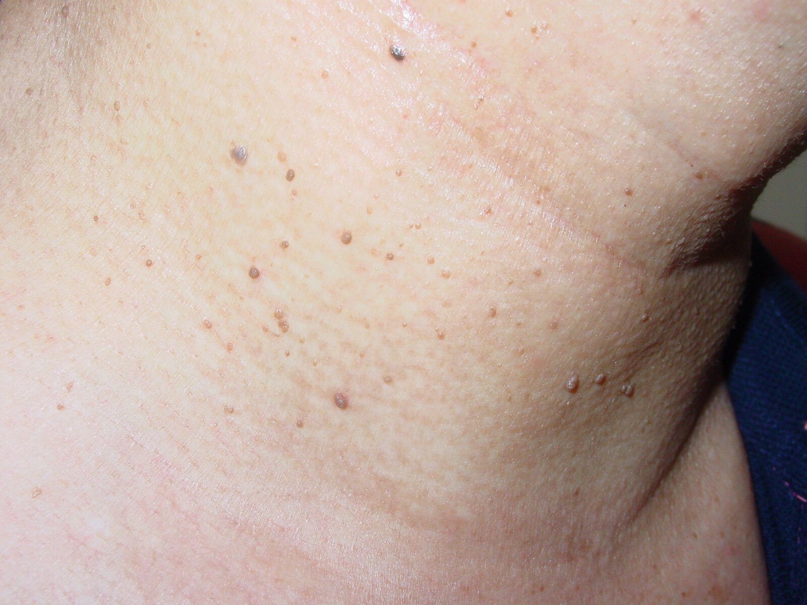 皮肤软纤维瘤图片早期图片