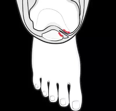 滑膜皱襞综合征～一种常见膝关节疼痛原因_关节痛_关节痛相关疾病