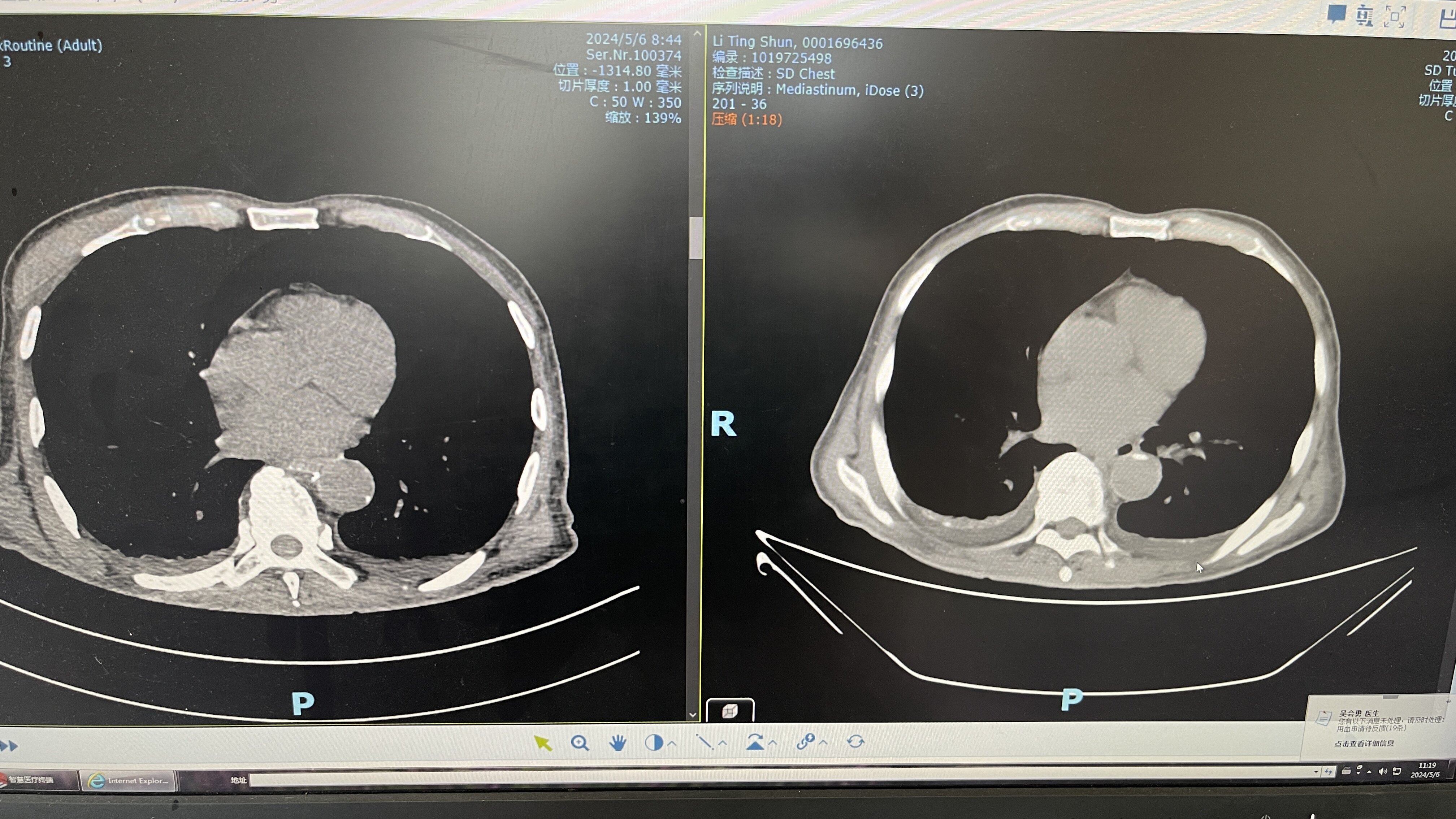 全身水肿伴乳糜腹又是胸导管阻塞惹的祸