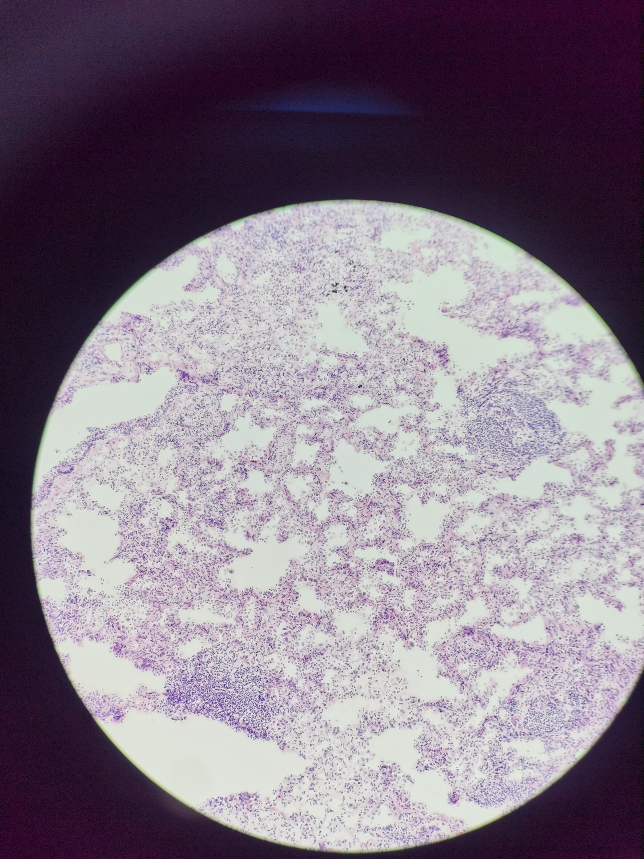 肺结节病理解析