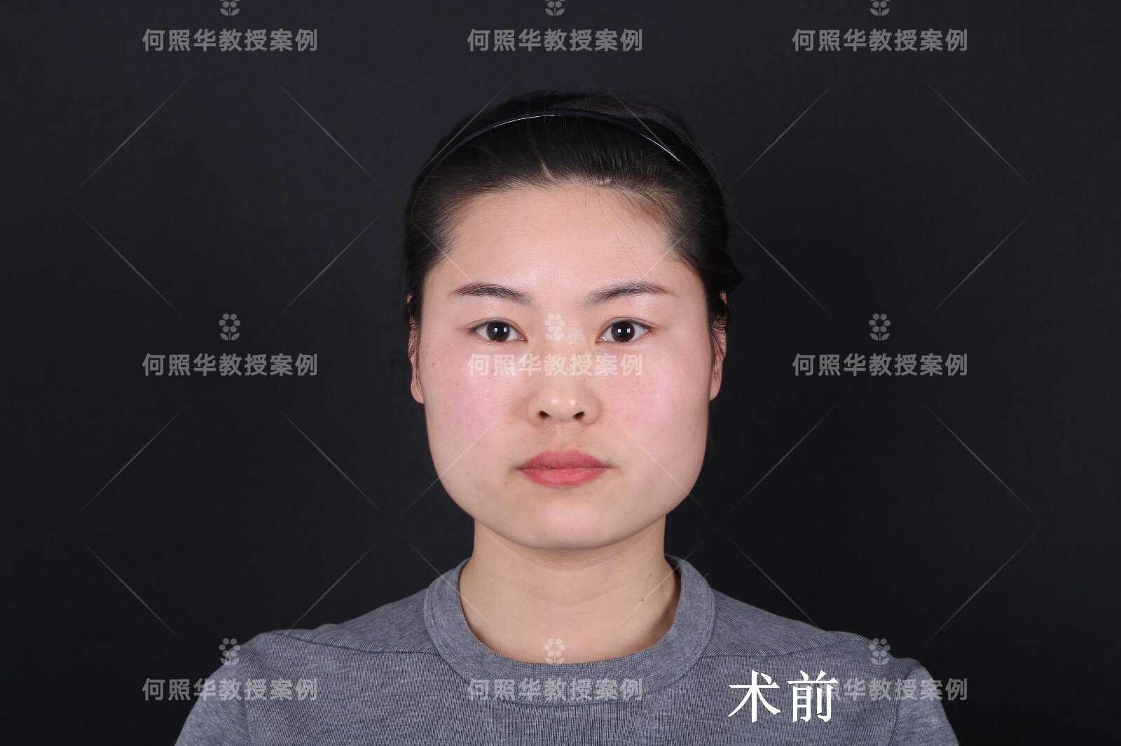 接近于90°,下颌角过于肥大,同时颧骨有些凸起,缺乏一种秀气;整个脸型