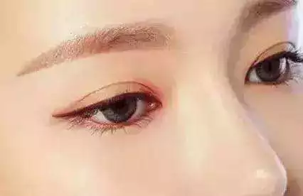 双眼皮做的太窄怎么办?可以加宽吗?