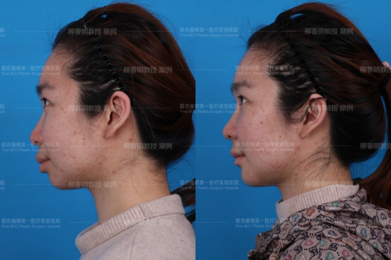 正颌手术凸嘴手术的难点在于它