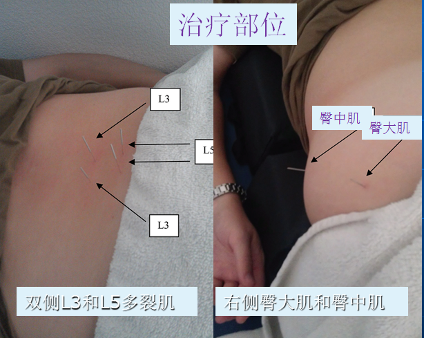 针法治疗腰臀痛 