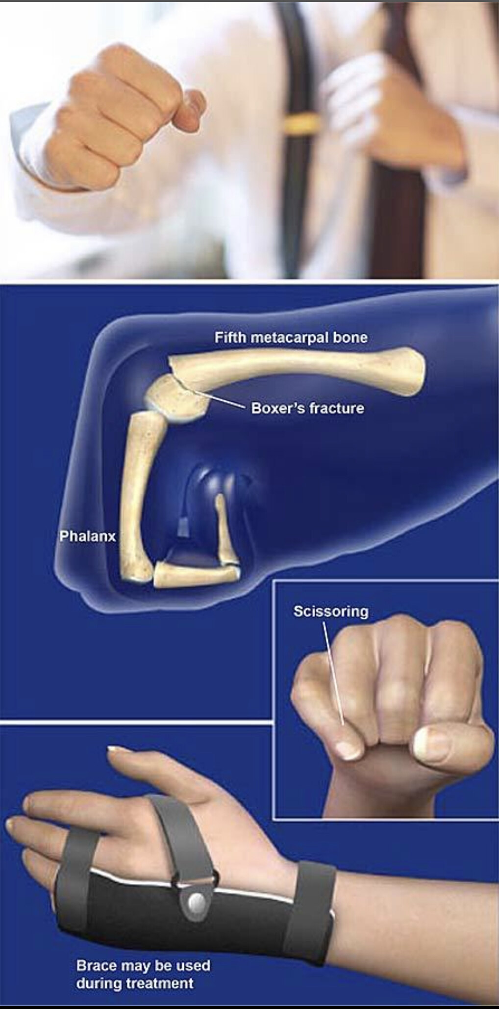 患者教育 拳击手骨折 掌骨骨折 手外伤 好大夫在线 患者教育 拳击手骨折 掌骨骨折 手外伤 好大夫在线