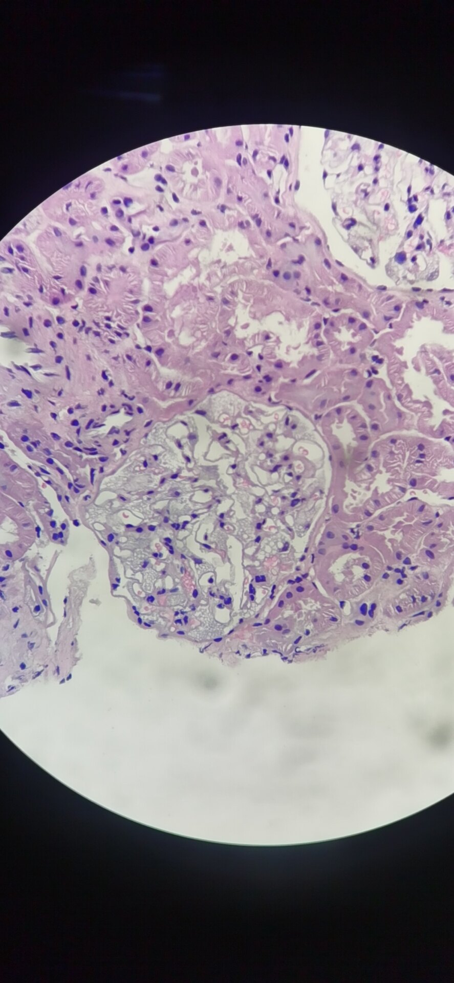 一例罕见的肾穿刺活检病例—怀疑法布里综合征fabrydisease - 好大夫