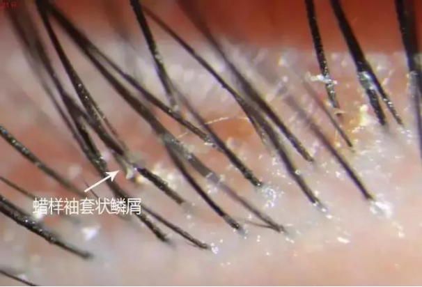 干眼的罪魁祸首之螨虫