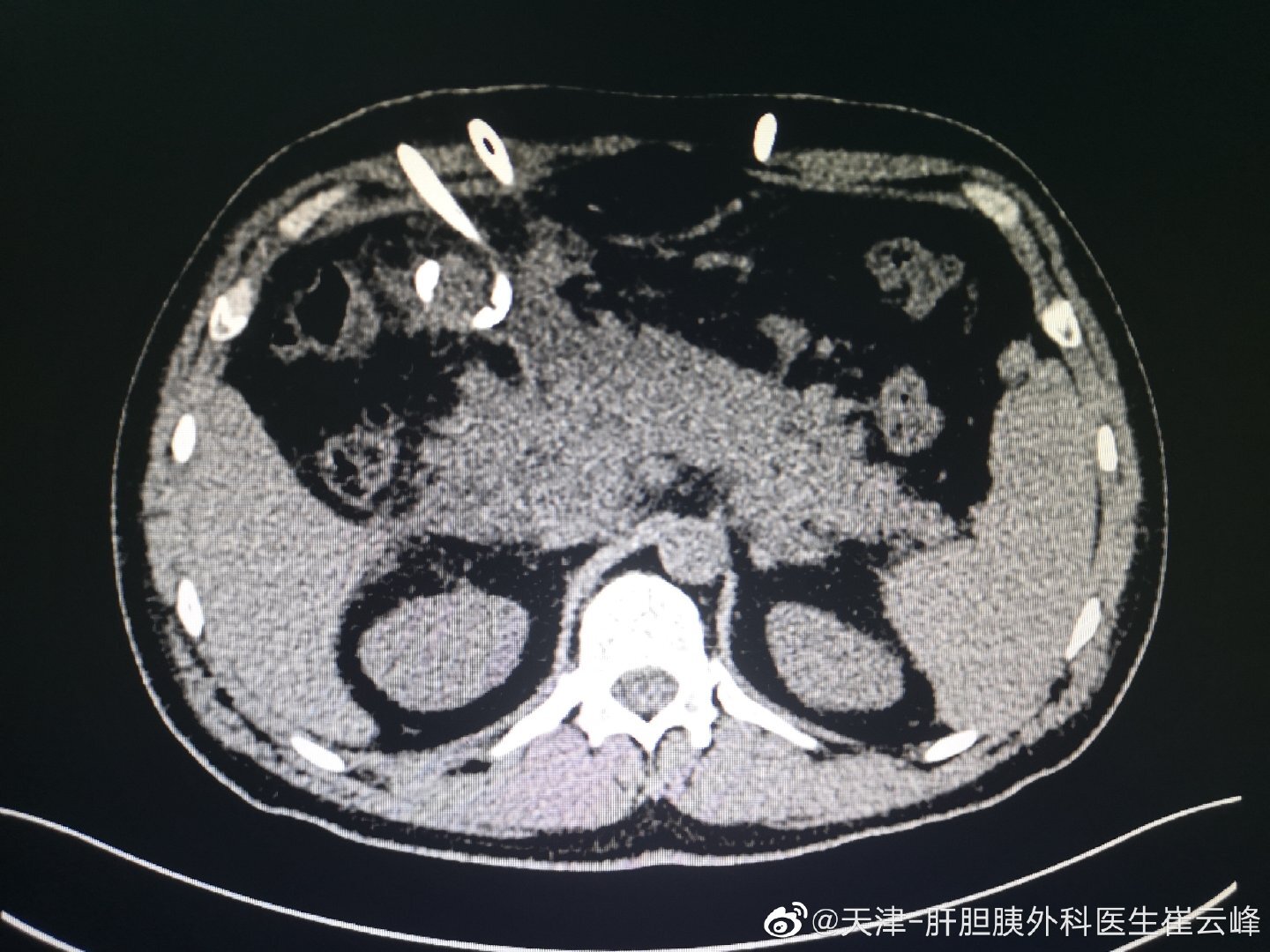 重症急性胰腺炎感染性胰腺坏死 好大夫在线