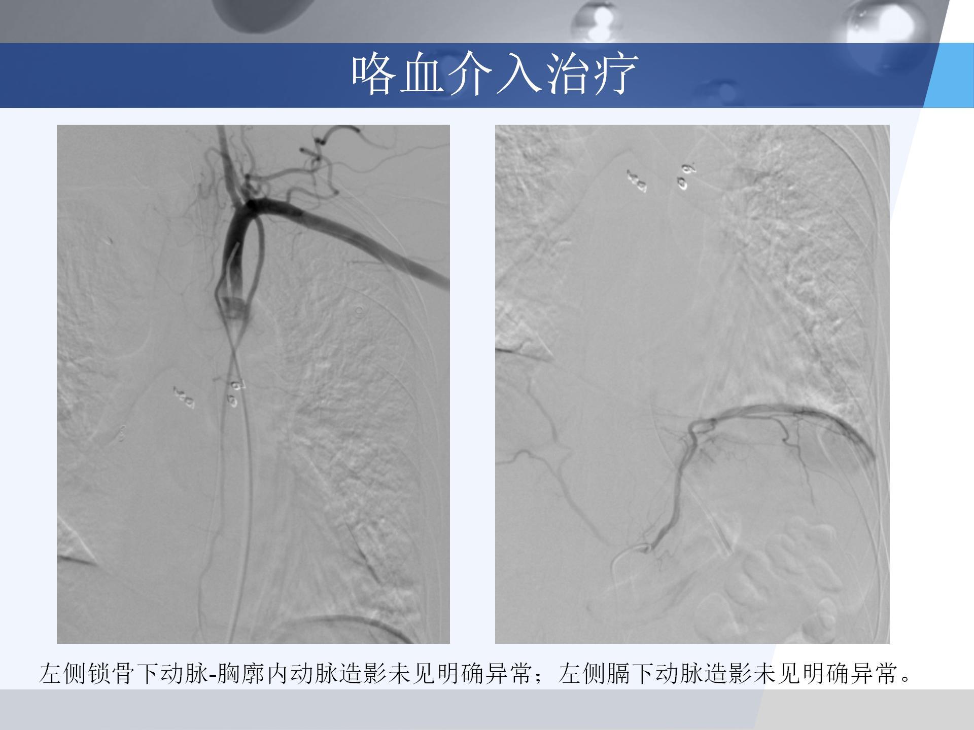 广医附一院-咯血病例汇报 [自动保存的]_11.jpg