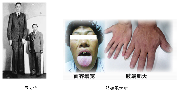 生长激素 Gh 型垂体瘤诊疗简介 垂体瘤 生长激素 Gh 型垂体瘤诊疗简介 垂体瘤