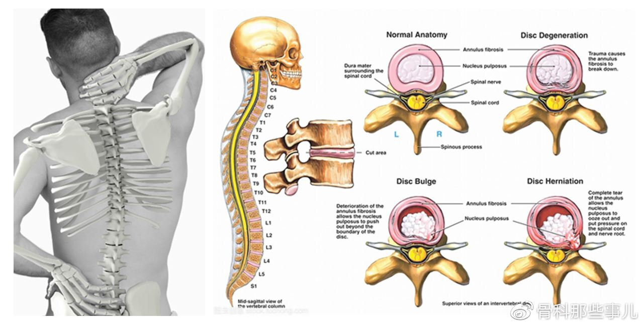 腰间盘内突和外凸的图图片