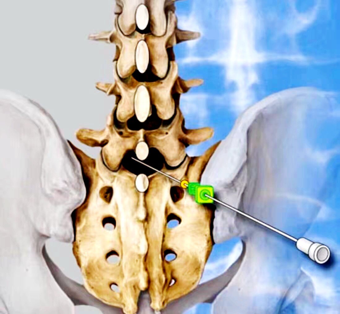 脊柱科普| 选择性神经根阻滞"一箭双雕"→诊断 治疗_腰椎管狭窄_腰椎