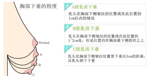 乳房悬韧带提升图片