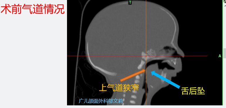 新生兒皮羅序列徵的外科治療_皮羅綜合徵_介紹_症狀表現_治療方式