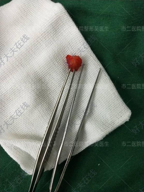 耳前瘘管_先天性耳前瘘管 - 好大夫在线