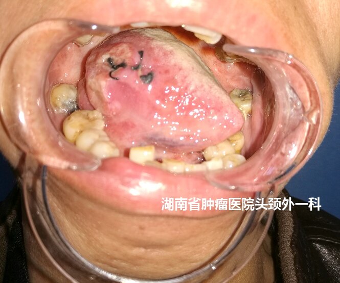 舌鳞癌图片
