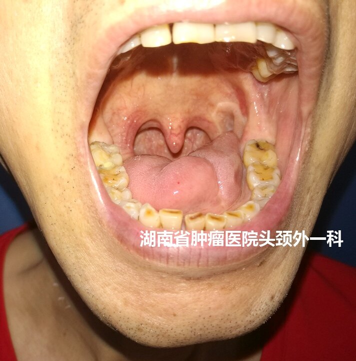 舌癌早期能治好吗图片