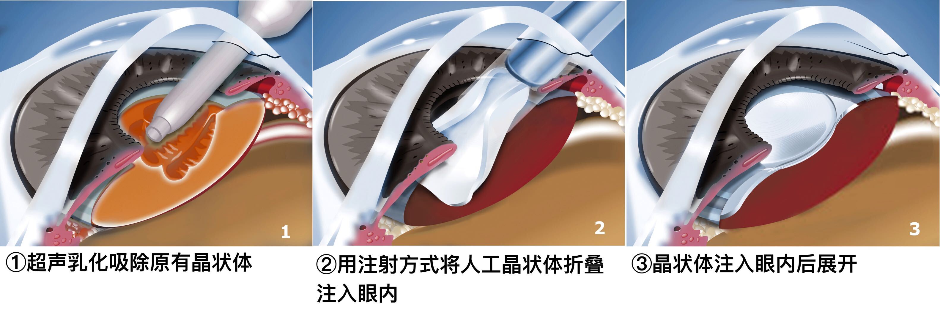 植入手术分为无晶状体眼人工晶体植入术和有晶状体眼人工晶体植入术