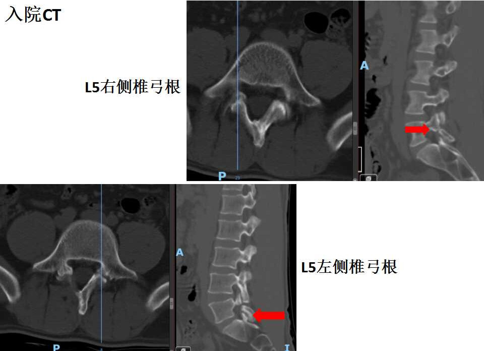 椎弓峡部裂CT图片