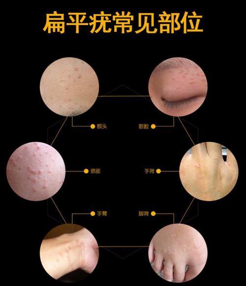 冠状沟珍珠疹图片_龟冠珍珠疹图片_珍珠疹图片初期图片