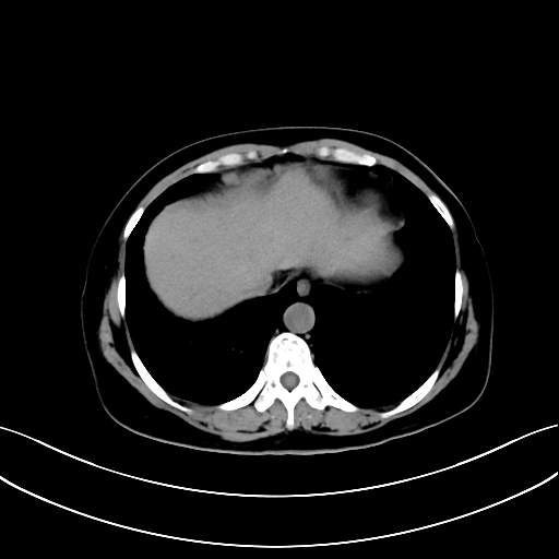妇科一病区完成一例心膈角淋巴结切除术(2020年11月) - 好大夫在线