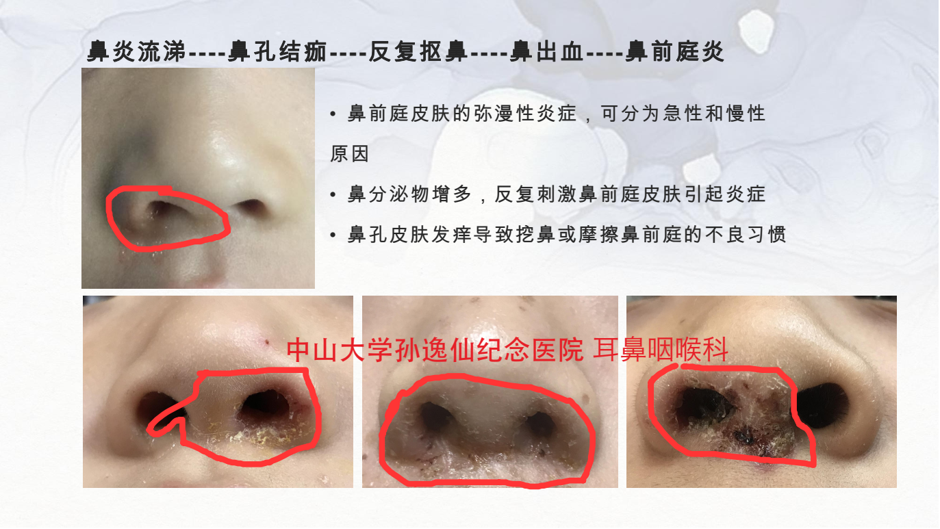 鼻炎主题 鼻涕多 鼻屎多 结痂导致鼻前庭炎合并鼻出血如何治疗 鼻前庭炎 鼻炎主题 鼻涕多 鼻屎多 结痂导致鼻前庭炎合并鼻出血如何治疗 鼻前庭炎