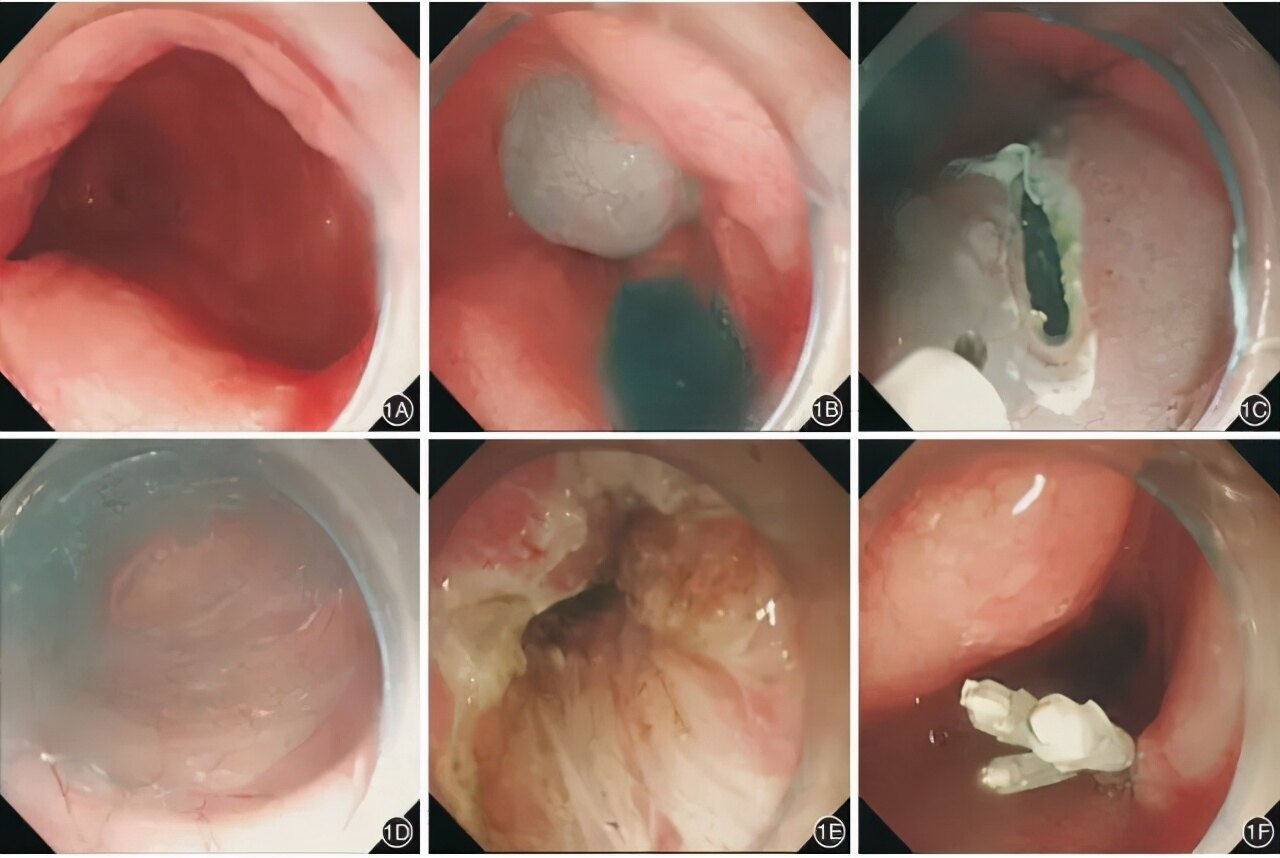 内镜下治疗贲门失驰缓症——poem_贲门失弛缓症_介绍_治疗方式_日常