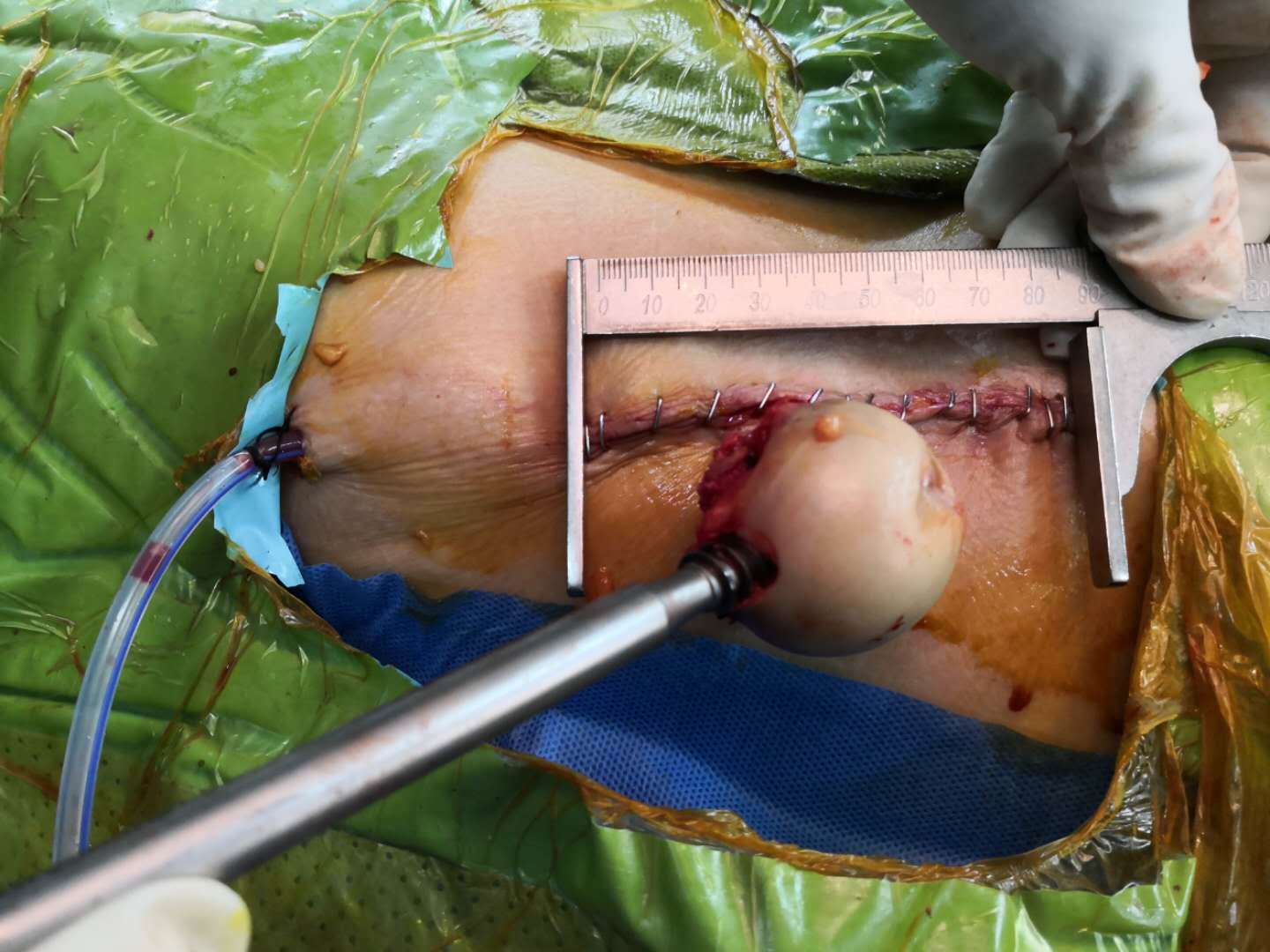 髋关节骨折,老年女,前路小切口置换术 - 好大夫在线