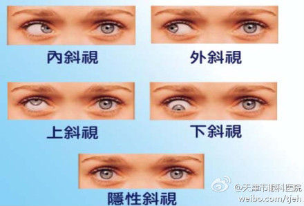 关于斜视常见的问题 - 好大夫在线
