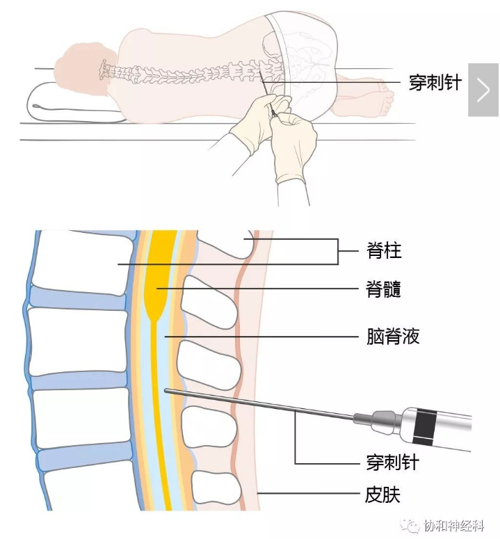腰椎穿刺部位体表定位图片