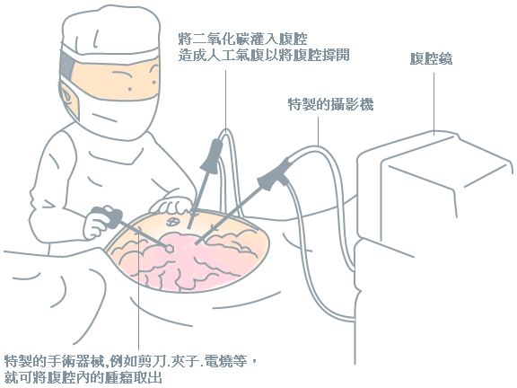 腹腔镜肾囊肿手术图解图片