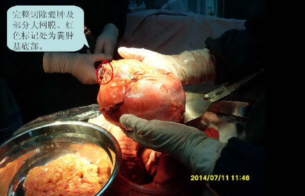 腹膜後腫瘤成年男性腹膜後畸胎瘤