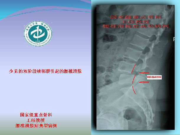 病例30一例少见的双阶段峡部裂引起的腰椎滑脱