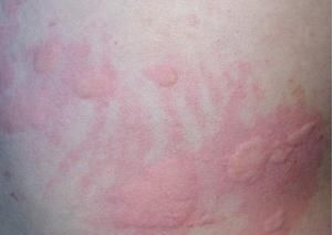 皮肤出现什么样的皮疹提示风湿免疫病?
