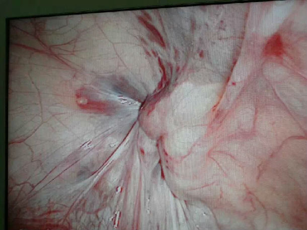 我院普外科成功开展了腹腔镜小儿疝手术