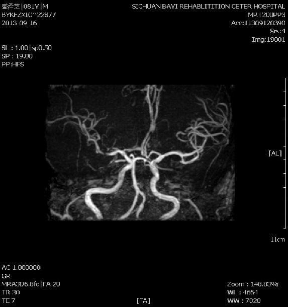 磁共振无对比剂血管成像技术(MRA、MRV)的临