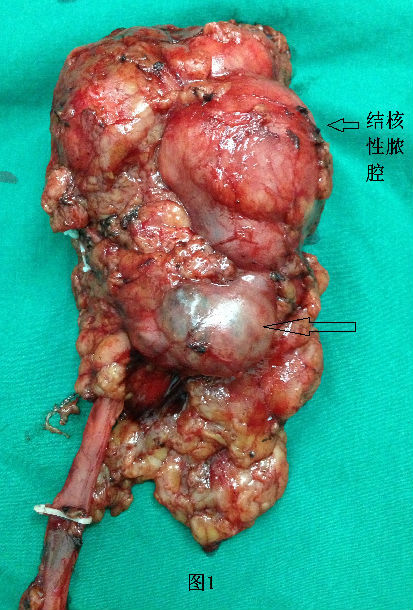 腹腔结核图片