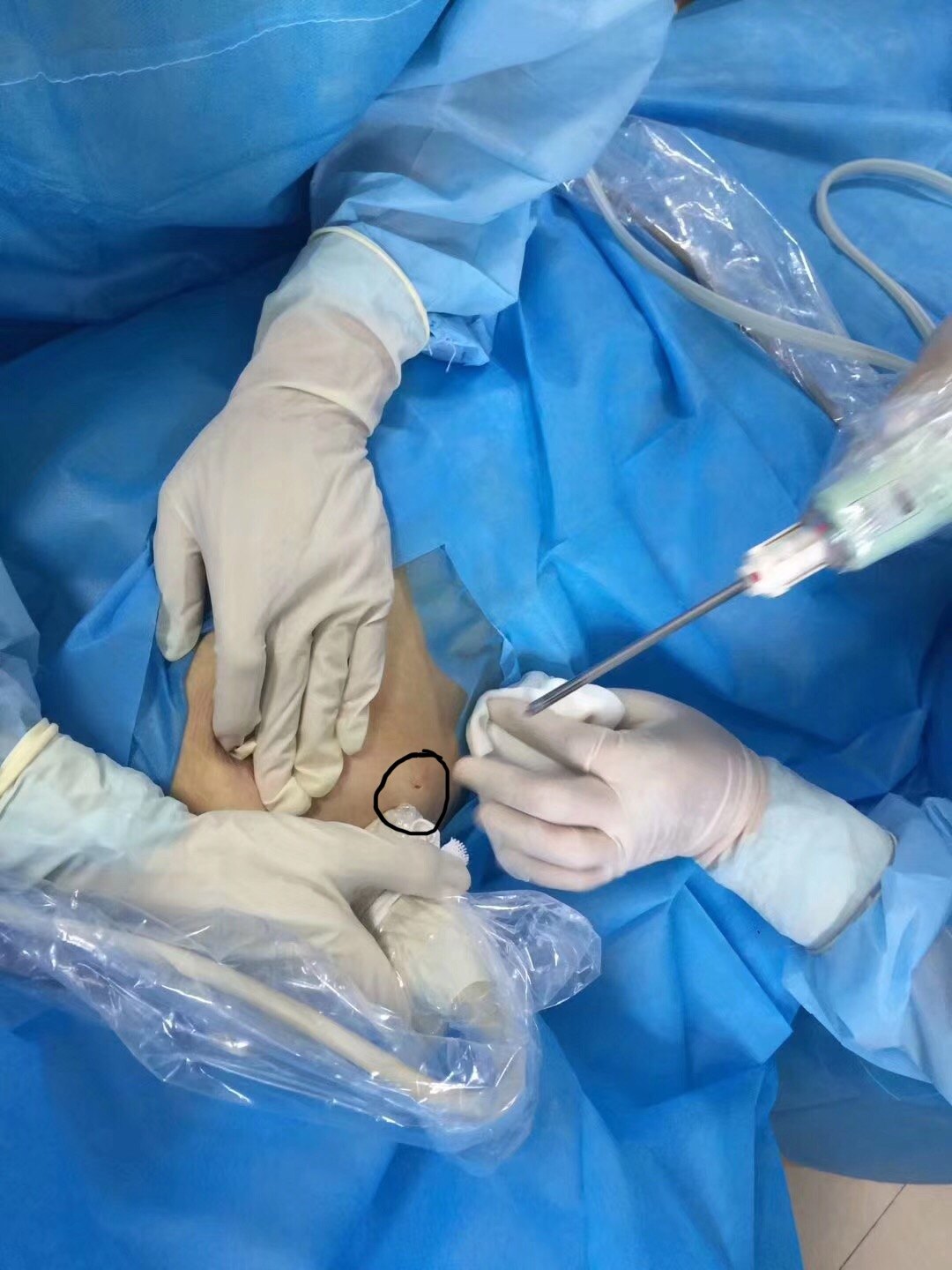 乳腺纤维瘤的手术选择 乳腺纤维瘤 乳腺纤维瘤手术