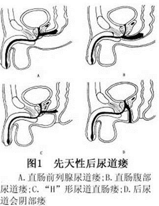 后天性尿道瘘的发生原因为①尿道损伤,如战伤,车祸,工伤事故时的尿道