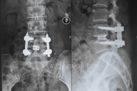 腰椎管狭窄症微创手术病例(2014.11)