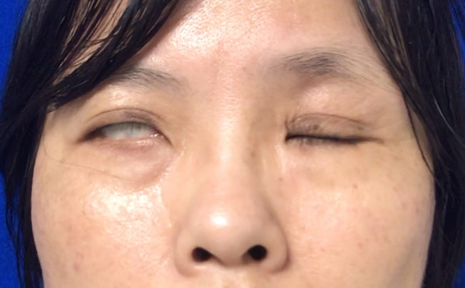 腮腺术后并发症的注射治疗_面瘫_治疗方法_治疗方式 - 好大夫在线